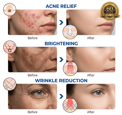 ReliefEase™ Light Therapy Mask